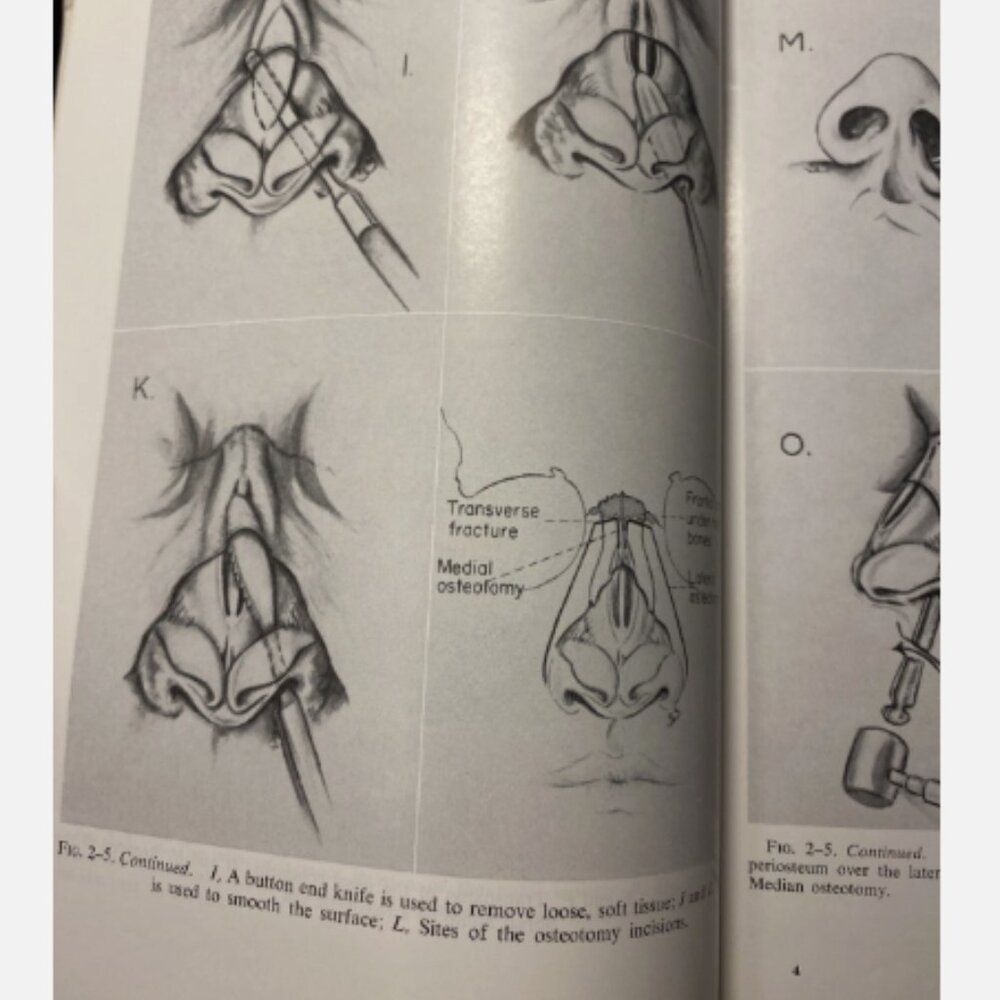 Diseases Of The Nose Throat And Ear 11th Ed John Jacob Ballenger - Picture 8 of 11